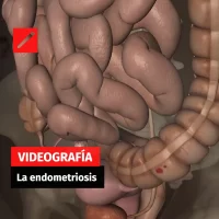 La endometriosis